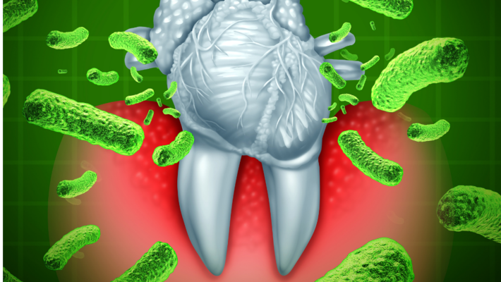 The mouth is not clean! The risk of pericarditis