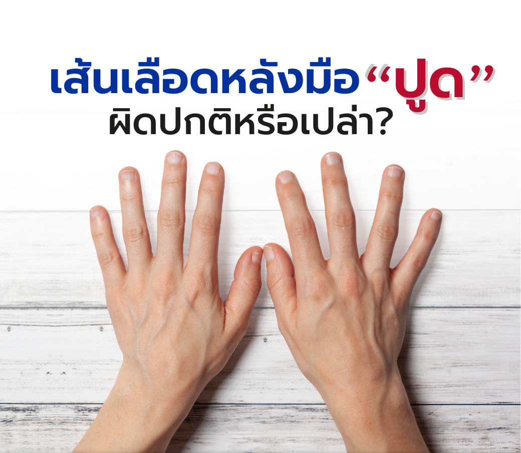 เส้นเลือดหลังมือปูดผิดปกติหรือเปล่า.png