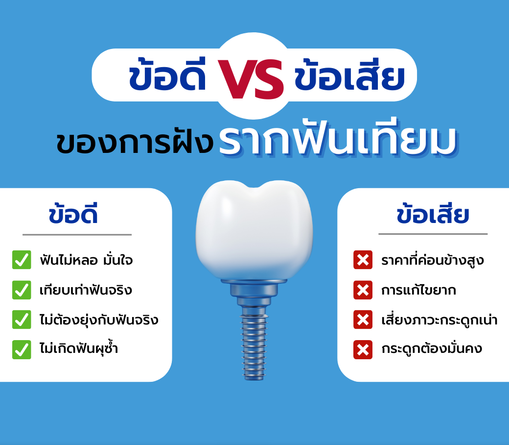 ข้อดีข้อเสียของการฝังรากฟันเทียม | โรงพยาบาลเชียงใหม่ ฮอสพิทอล | โทร : 053  225 222